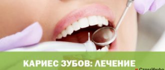 Кариес зубов: лечение в домашних условиях