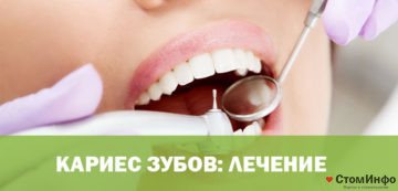 Кариес зубов: лечение в домашних условиях