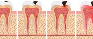 Caries