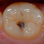 кариеса дентина