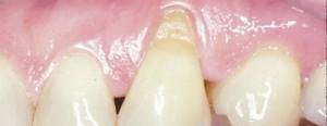 клиновидный дефект зубов фото