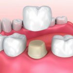 коронки на зубы