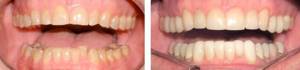 коррекция зубов винирами в стоматологии
