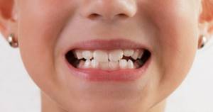 Кривые коренные зубы у ребенка