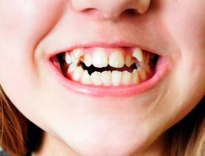 Кривые зубы у ребенка: советы родителям и методы профилактики