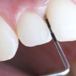 Кюретаж десен