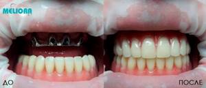 лечение адентии зубов верхней челюсти