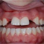 Лечение агенезии верхнего латерального резца посредством протезирования на имплантате