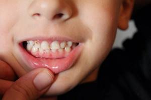Лечение гипоплазии зубов
