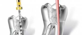 root canal treatment
