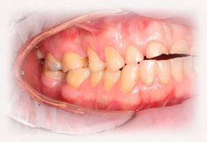 Лечение повышенной стираемости зубов