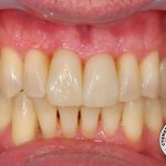Легкая форма пародонтита