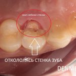 Линия скола зуба прошла глубоко под десной - лечение в клинике ДенМед
