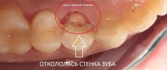 Линия скола зуба прошла глубоко под десной - лечение в клинике ДенМед