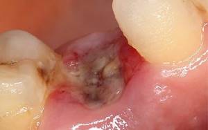 Лунка после удаления зуба альвеолит