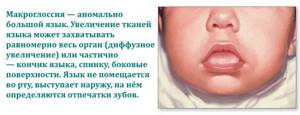 макроглоссия у новорожденных