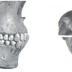 Методы исправления дефектов постоянного прикуса