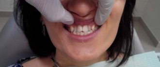 Методы лечения скученности зубов
