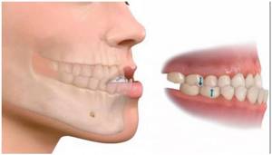 Мезиальное положение зубов