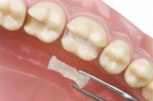 микропротезы зубов