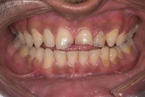 Минимально инвазивный подход к лечению эрозивной потери твердых тканей зубов