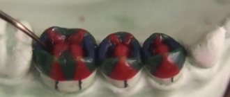 wax teeth modeling