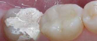 мышьяк в стоматологии: что это такое, как хранить, есть ли его заменитель