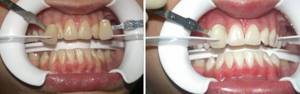 На фото показаны зубы до и после отбеливания