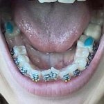 bite fillings for braces