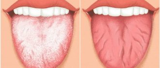Coated tongue