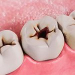 Наличие невылеченного кариеса - Стоматология Линия Улыбки