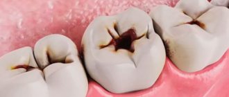 Presence of untreated caries - Smile Line Dentistry