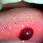 налитый кровью волдырь