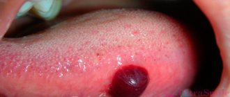 bloodshot blister
