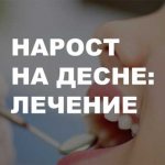 нарост на десне