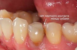 Нарушение плотности между коронкой и зубами