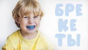 Недостатки брекетов для молочных зубов