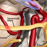 Невралгия троичного нерва