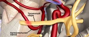Невралгия троичного нерва
