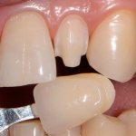 Grinded tooth and veneer