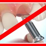 Ограничения к имплантации