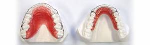 Ортодонтическая детская пластинка