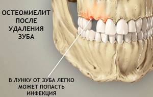 X-ray diagnosis of odontogenic osteomyelitis of the jaws in persons ...