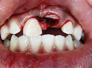 Острая травма детского зуба