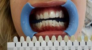 Отбеливание зубов лампой холодного света: использование шкалы Вита для определения цвета эмали