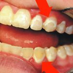 Отбеливание зубов после брекетов