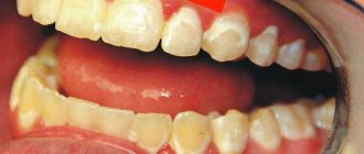 Отбеливание зубов после брекетов