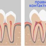 отсутствие правильного контактного пункта между зубами