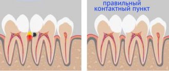 отсутствие правильного контактного пункта между зубами