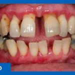 Patient before dental implantation surgery for periodontitis. The smile area of ​​the upper jaw is in a painful state. Periodontitis treatment and complete jaw implantation are required. 